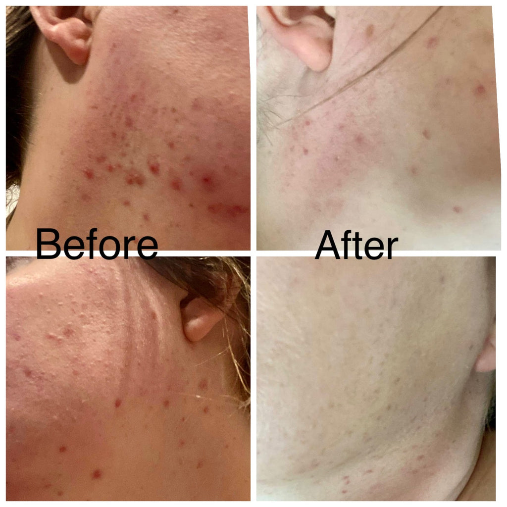 Acne: what causes acne and how skincare can help