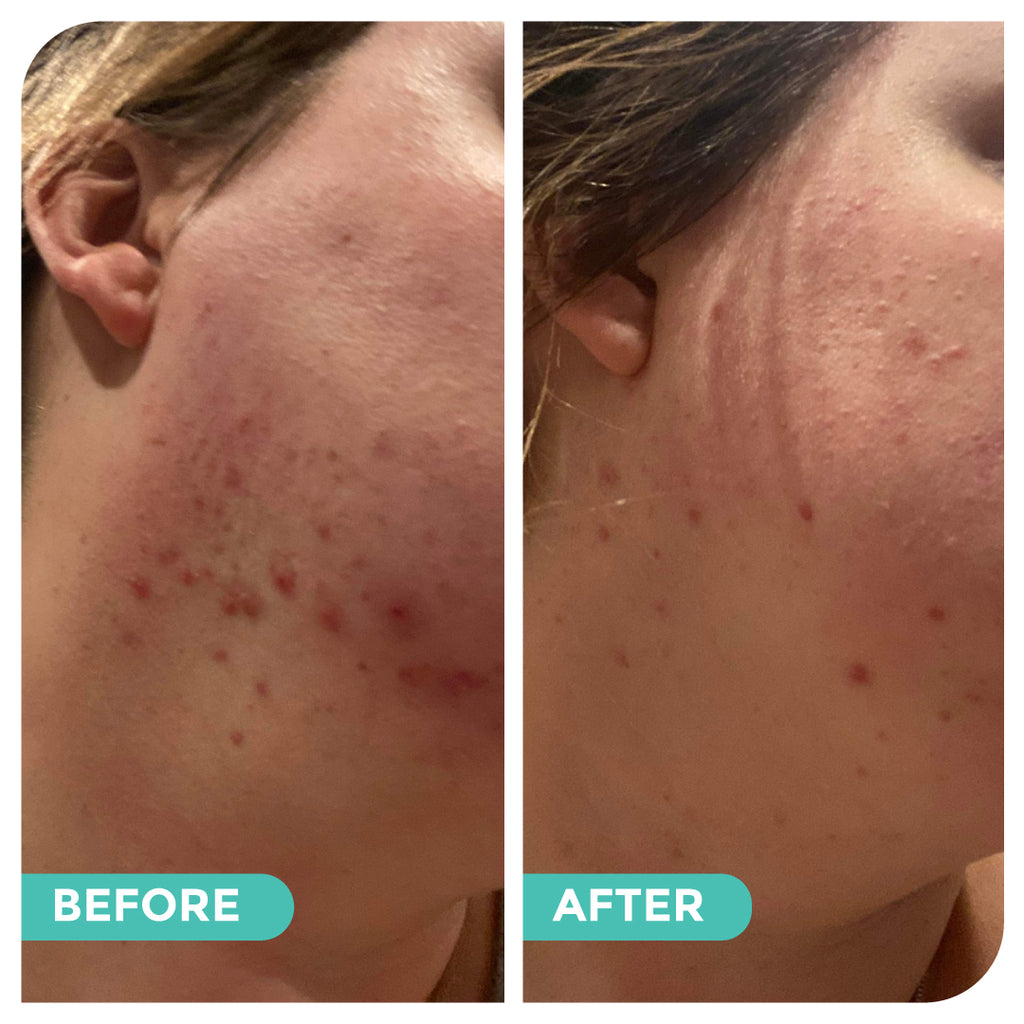 Before and after pictures from using Hemp Co Australia Oil cleanser 